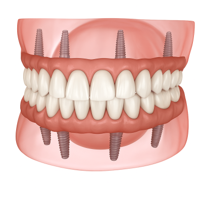 Full Mouth Reconstruction in Albania