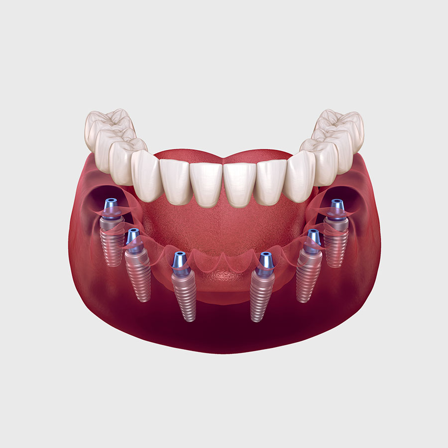 Dental implants