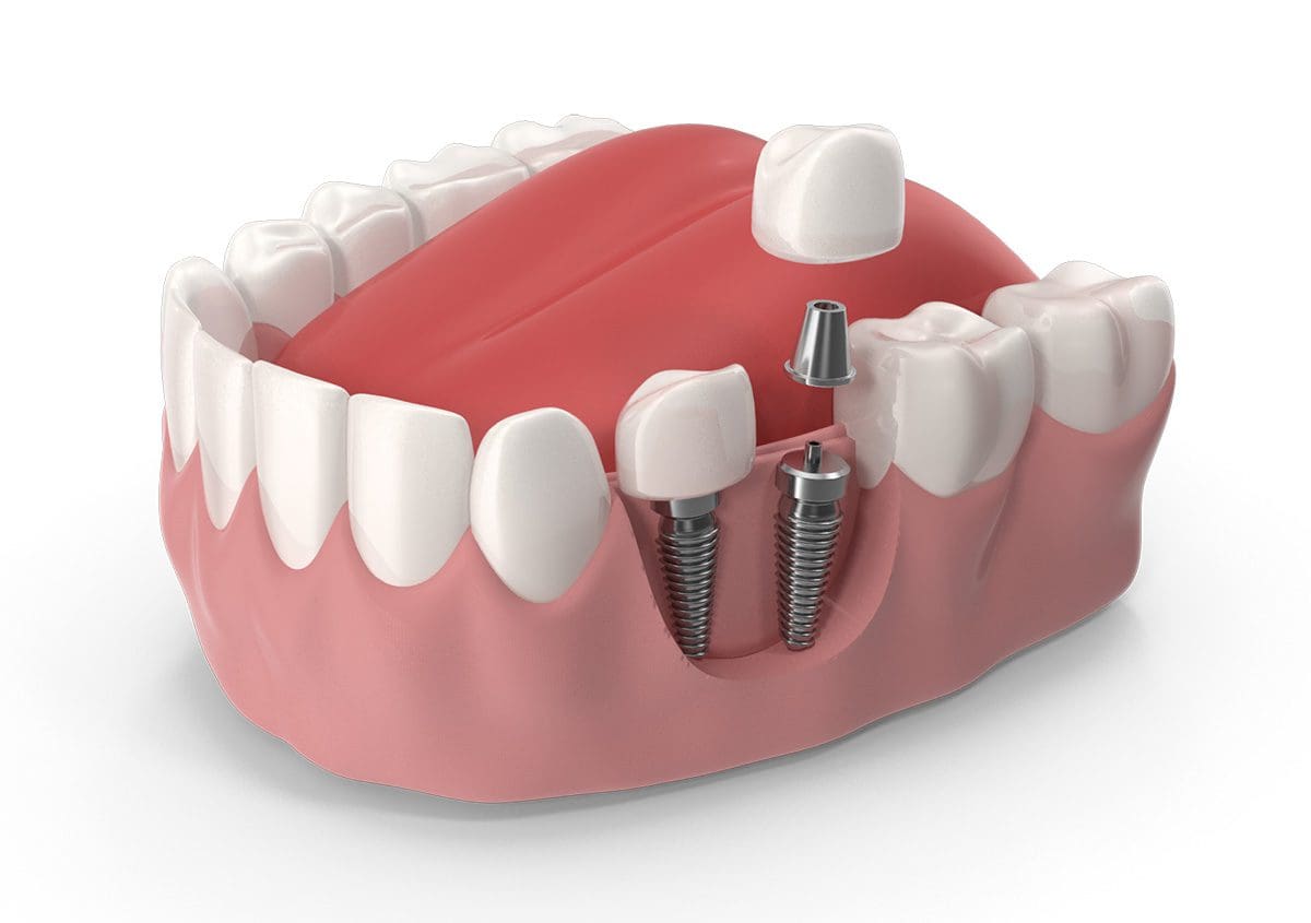 impianto-dentale-completo Impianto dentale completo